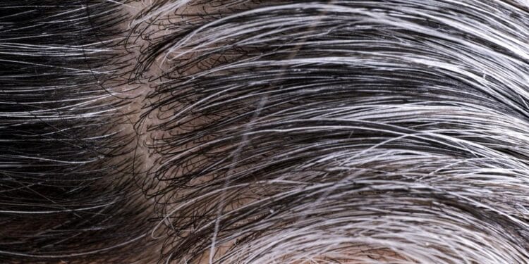 Hair Care TIPS: Get rid of white hair, easy home tips to follow