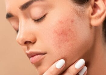 Skin Care If you want to get rid of facial boils and spots, then adopt these 5 home remedies, it will take effect immediately