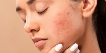 Skin Care If you want to get rid of facial boils and spots, then adopt these 5 home remedies, it will take effect immediately