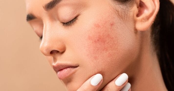 Skin Care If you want to get rid of facial boils and spots, then adopt these 5 home remedies, it will take effect immediately