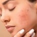 Skin Care If you want to get rid of facial boils and spots, then adopt these 5 home remedies, it will take effect immediately