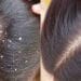 Get rid of dandruff in hair, know special ways