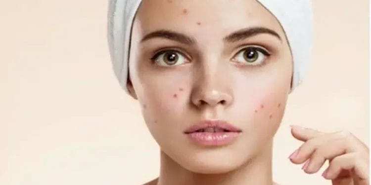 Apply multani mitti on the face like this, acne will disappear