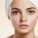 Apply multani mitti on the face like this, acne will disappear