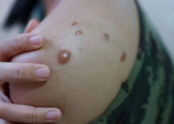 Monkeypox Virus is spreading in India too, know its symptoms and ways to avoid it