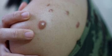 Monkeypox Virus is spreading in India too, know its symptoms and ways to avoid it