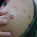 Monkeypox Virus is spreading in India too, know its symptoms and ways to avoid it