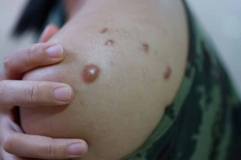 Monkeypox Virus is spreading in India too, know its symptoms and ways to avoid it