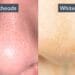 blackheads and whiteheads