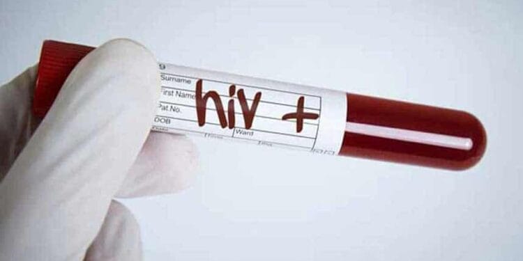 HIV+ve