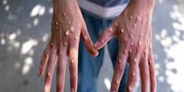 It is necessary for states and UTs to prepare at the district level regarding monkeypox, the Center has said…