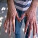 It is necessary for states and UTs to prepare at the district level regarding monkeypox, the Center has said…