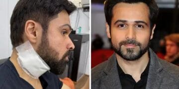 Emraan Hashmi injured during shooting, pictures went viral